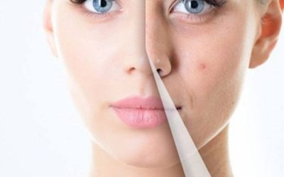 Peeling Facial: Antes, durante y despues
