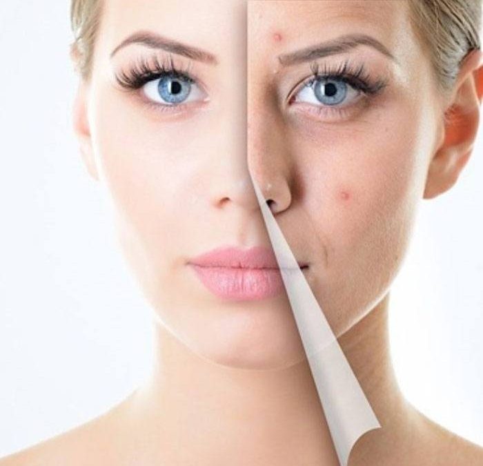 Peeling Facial: Antes, durante y despues