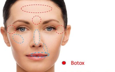 Diferencias entre el botox y el ácido hialurónico