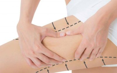 Recomendaciones a tener en cuenta en la mesoterapia