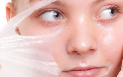 ¿Qué es un peeling facial químico?